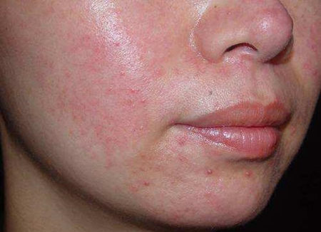 干性皮肤为什么会长痘，怎么办  干性皮肤 美白祛黄 第3张