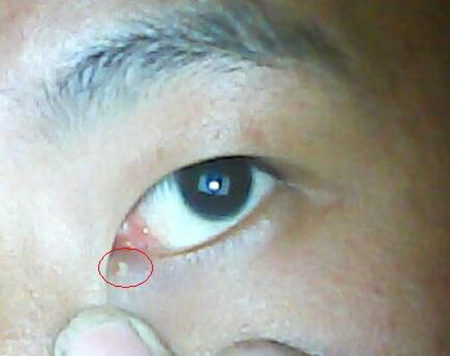 眼角长痘痘是什么原因，怎么办