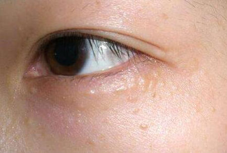 眼角长痘痘是什么原因，怎么办  眼角 长痘 原因 美白祛黄 第2张