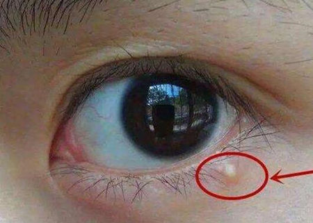 眼角长痘痘是什么原因，怎么办  眼角 长痘 原因 美白祛黄 第4张