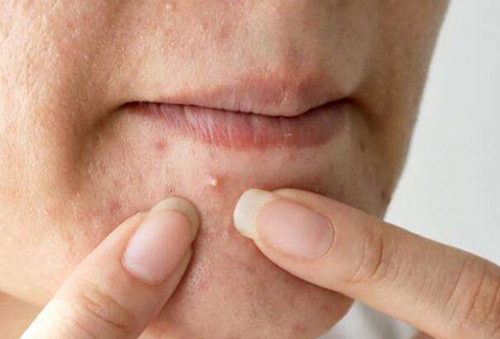 脸上挤出硬粒是螨虫吗，怎么去螨虫痘痘