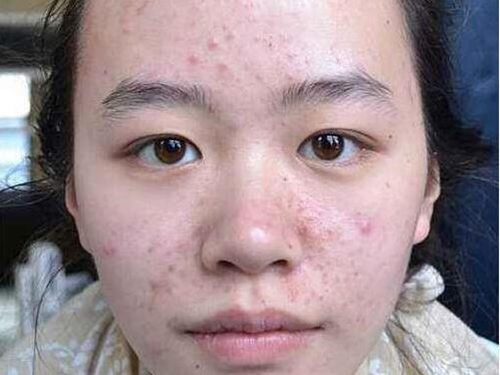 脸上挤出硬粒是螨虫吗，怎么去螨虫痘痘  螨虫 螨虫痘 脸上 美白祛黄 第2张