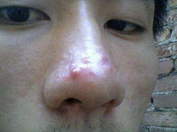 鼻子上摸着痛又挤不出来的痘怎么办