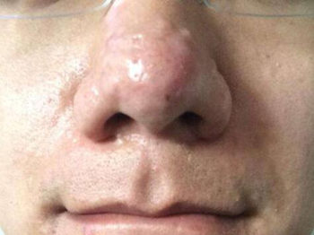 鼻子上摸着痛又挤不出来的痘怎么办  鼻子 美白祛黄 第2张