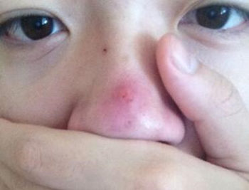 鼻子上摸着痛又挤不出来的痘怎么办  鼻子 美白祛黄 第3张