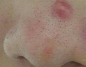 鼻子上摸着痛又挤不出来的痘怎么办  鼻子 美白祛黄 第5张