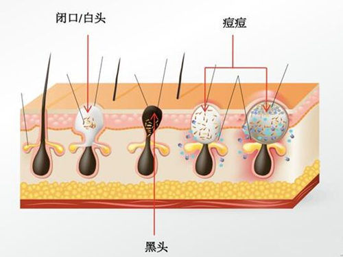 闭口自己消失的原理分析，怎么加速闭口消失