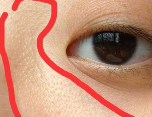 闭口自己消失的原理分析，怎么加速闭口消失  闭口 美白祛黄 第2张