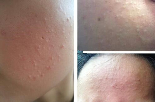 闭口自己消失的原理分析，怎么加速闭口消失  闭口 美白祛黄 第3张