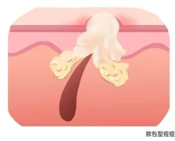 有脓的痘痘如何处理，脓包型痘痘处理方法  痘痘 脓包 方法 美白祛黄 第2张