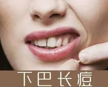 女性下巴长痘痘咋调理，这五个方法很实用