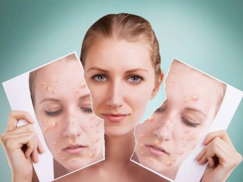 脸部痤疮最佳治疗方法，有效六种  痤疮 治疗方法 脸部 美白祛黄 第6张