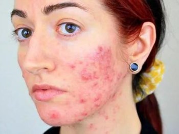 严重痤疮一般多久能好，痊愈莫着急