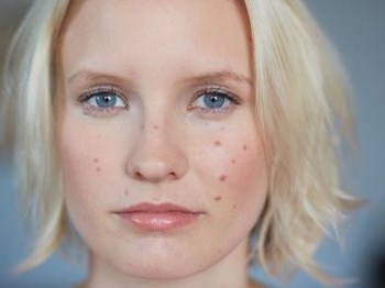 严重痤疮一般多久能好，痊愈莫着急  痤疮 美白祛黄 第2张