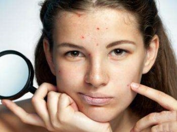 严重痤疮一般多久能好，痊愈莫着急  痤疮 美白祛黄 第4张