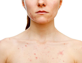 痤疮发炎红肿是什么原因，怎么办