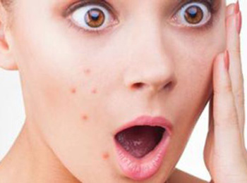 痤疮发炎红肿是什么原因，怎么办  痤疮发炎 美白祛黄 第2张