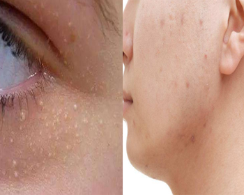 脂肪粒跟粉刺的区别，教你区分脂肪粒与闭口