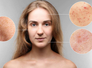 脂肪粒跟粉刺的区别，教你区分脂肪粒与闭口  脂肪粒 粉刺 美白祛黄 第4张