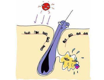 脂肪粒跟粉刺的区别，教你区分脂肪粒与闭口  脂肪粒 粉刺 美白祛黄 第5张