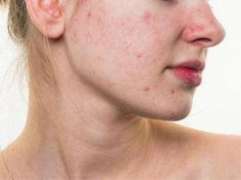 脸上有炎症痘痘怎么处理，日常护理小方法  炎症 痘痘 美白祛黄 第4张