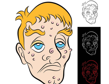 青春痘快速消除老方法，四个偏方治疗青春痘