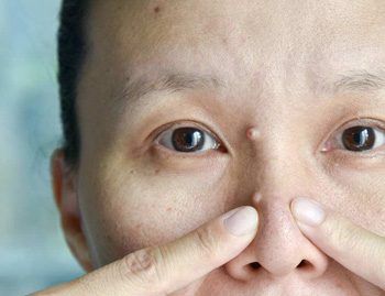 痤疮留下的硬块能好吗，怎么去除