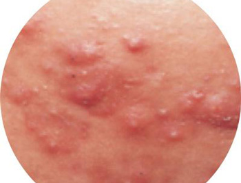 囊肿性痘痘怎么排出来，5种快速改善  囊肿 痘痘 美白祛黄 第4张