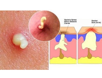 囊肿性痘痘怎么排出来，5种快速改善  囊肿 痘痘 美白祛黄 第5张