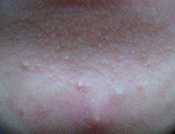 闭口粉刺发炎了怎么办，教你消灭发炎闭口