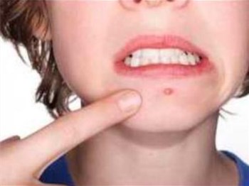 月经前长痘痘什么原因怎么调理  痘痘 月经 原因 美白祛黄 第2张