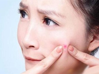 月经前长痘痘什么原因怎么调理  痘痘 月经 原因 美白祛黄 第3张