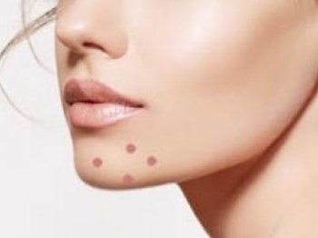 月经前长痘痘什么原因怎么调理  痘痘 月经 原因 美白祛黄 第4张