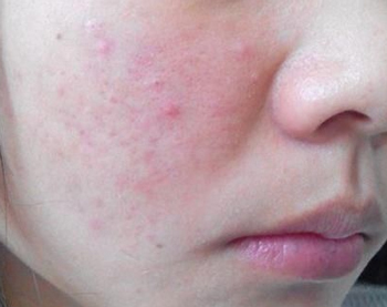 毛孔堵塞长痘如何疏通，教你合理疏通毛孔祛痘