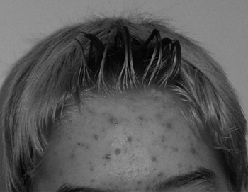 青春痘什么年龄会消失，青春痘的起承转合  青春痘 年龄 美白祛黄 第4张