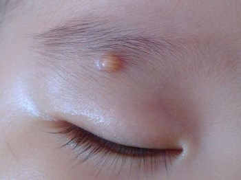 眉毛里长痘痘什么原因怎么办  里长 痘痘 眉毛 美白祛黄 第2张