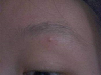 眉毛里长痘痘什么原因怎么办  里长 痘痘 眉毛 美白祛黄 第4张