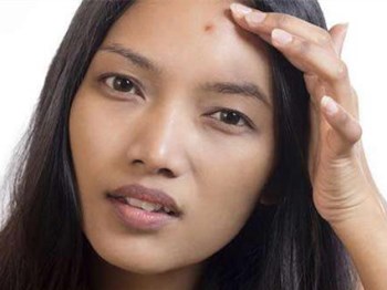 脸上T区长痘痘怎么调理，找准原因祛痘  区长 痘痘 美白祛黄 第3张