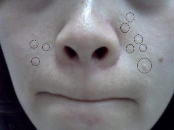 闭**痘好不好、怎么办，正确对待闭口变痘痘  怎么办 美白祛黄 第2张