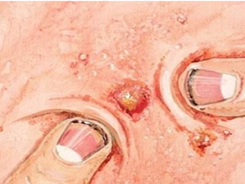 痘痘发炎怎么快速消炎，五种解决炎症痘肌