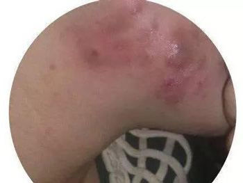 青少年如何消除青春痘，4种方式促进修复  青春痘 美白祛黄 第2张