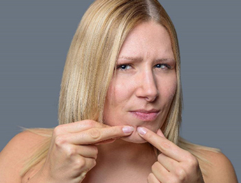 闭合性粉刺挤掉好还是不挤好  闭合性粉刺 美白祛黄 第4张