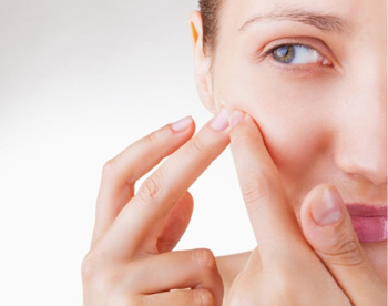 闭合性粉刺挤掉好还是不挤好  闭合性粉刺 美白祛黄 第5张