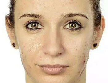 更年期长痘痘的原因，如何调理  更年期长痘 美白祛黄 第2张