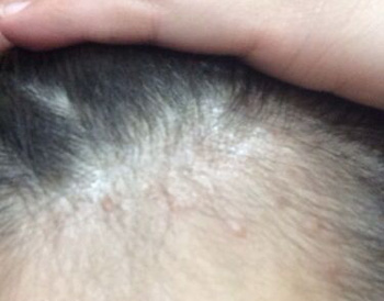 发际边缘长痘是什么原因，排除4种原因消除痘痘  长痘的原因 美白祛黄 第2张