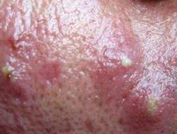 发际边缘长痘是什么原因，排除4种原因消除痘痘  长痘的原因 美白祛黄 第3张