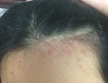 发际边缘长痘是什么原因，排除4种原因消除痘痘  长痘的原因 美白祛黄 第4张
