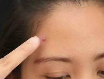 脸干长痘痘是什么原因，怎么办  脸干长痘 美白祛黄 第2张