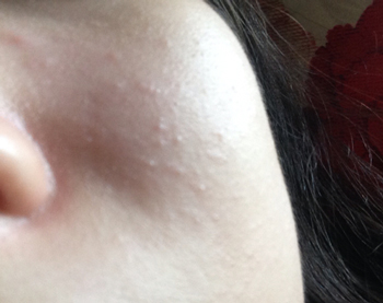 鼻子两侧长小米粒疙瘩，你所不知道的小疙瘩