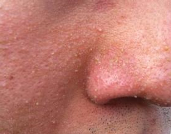 鼻子两侧长小米粒疙瘩，你所不知道的小疙瘩  疙瘩 米粒 鼻子 美白祛黄 第2张